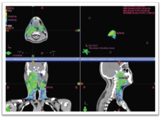 oncologyradiotherapy-Dosimetry