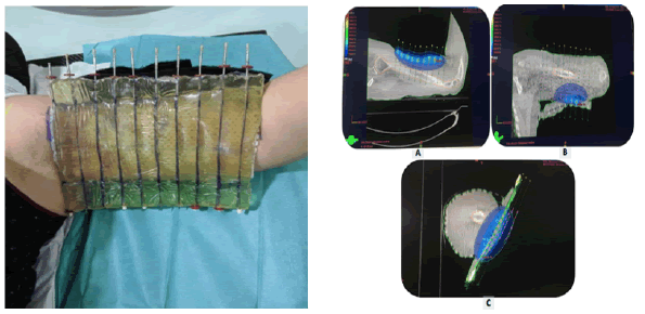 oncologyradiotherapy-HDR