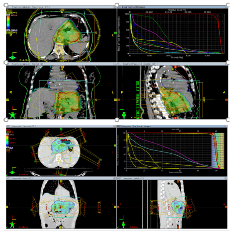 oncologyradiotherapy-VMAT