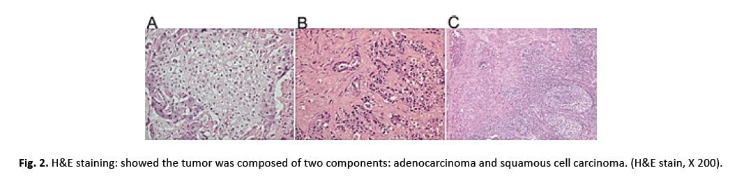 oncologyradiotherapy-adenocarcinoma