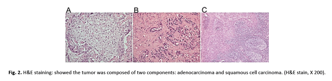 oncologyradiotherapy-adenocarcinoma oncologyradiotherapy-adenocarcinoma