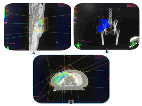 oncologyradiotherapy-desmoid