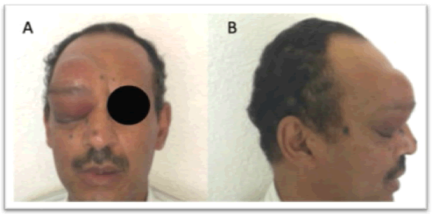 oncologyradiotherapy-exophthalmos