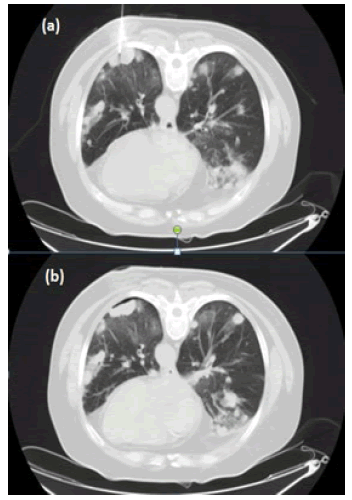 oncologyradiotherapy-mass