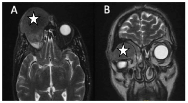 oncologyradiotherapy-metastasis