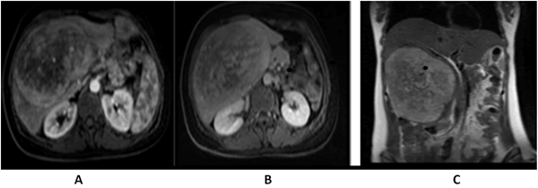 oncology-abdomen
