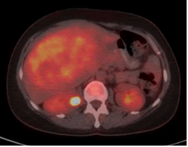 oncology-positron