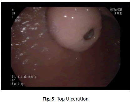 oncologyradiotherapy-Ulceration