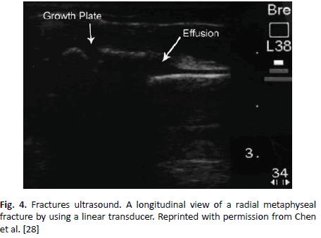 oncologyradiotherapy-fractures