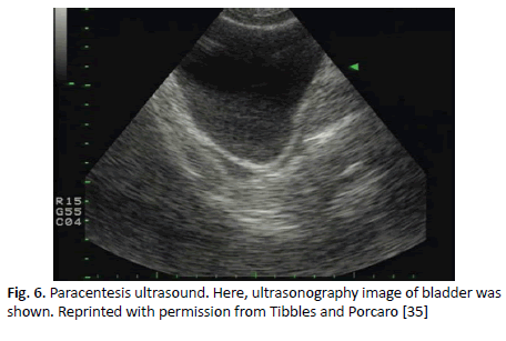 oncologyradiotherapy-paracentesis