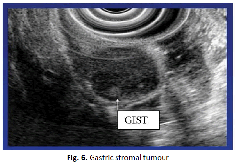 oncologyradiotherapy-stromal-tumour